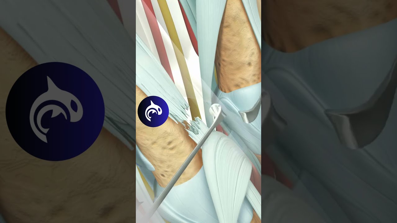 See How An Extensor Tendon Injury Of The Hand Is Repaired 3D Animation