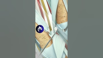 See how an Extensor Tendon Injury of the Hand is Repaired - 3D Animation