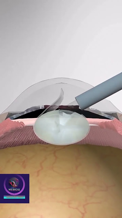 Cataract Surgery - 3D Animation