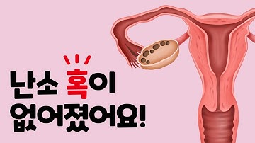 난소 혹 없어졌어요! 다낭성 난소 증후군 치료 방법