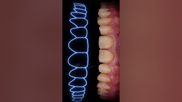 Thiết kế nụ cười - Design Smile Veneer #veneer #dansu