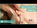 Multiple corn removal: Left foot