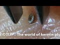 【No.15】またもや巨大角栓!Big keratin plug!!