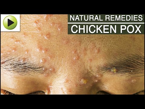 Skin Care - Chicken Pox - Natural Ayurvedic Home Remedies