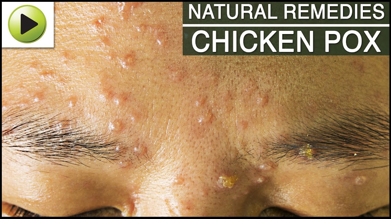 chicken pox pictures in adults