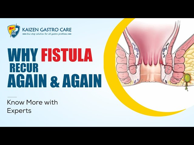 Why Fistula Occurs Again & Again  Know from Experts - Dr Samrat Jankar  #RecurrenceFistula #Fistula 