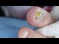 Ep_2768 Toenail removal 👣 เล็บห่อ..ม้วน ม้วน 😷 (This clip is from Thailand)