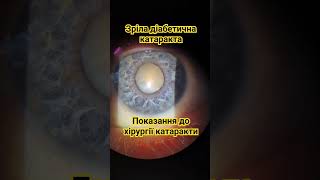 Mature diabetic cataract | Зріла діабетична катаракта | Зрелая диабетическая катаракта