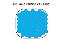 胸部X線写真読影キーワード解説動画11-1　コンソリデーション