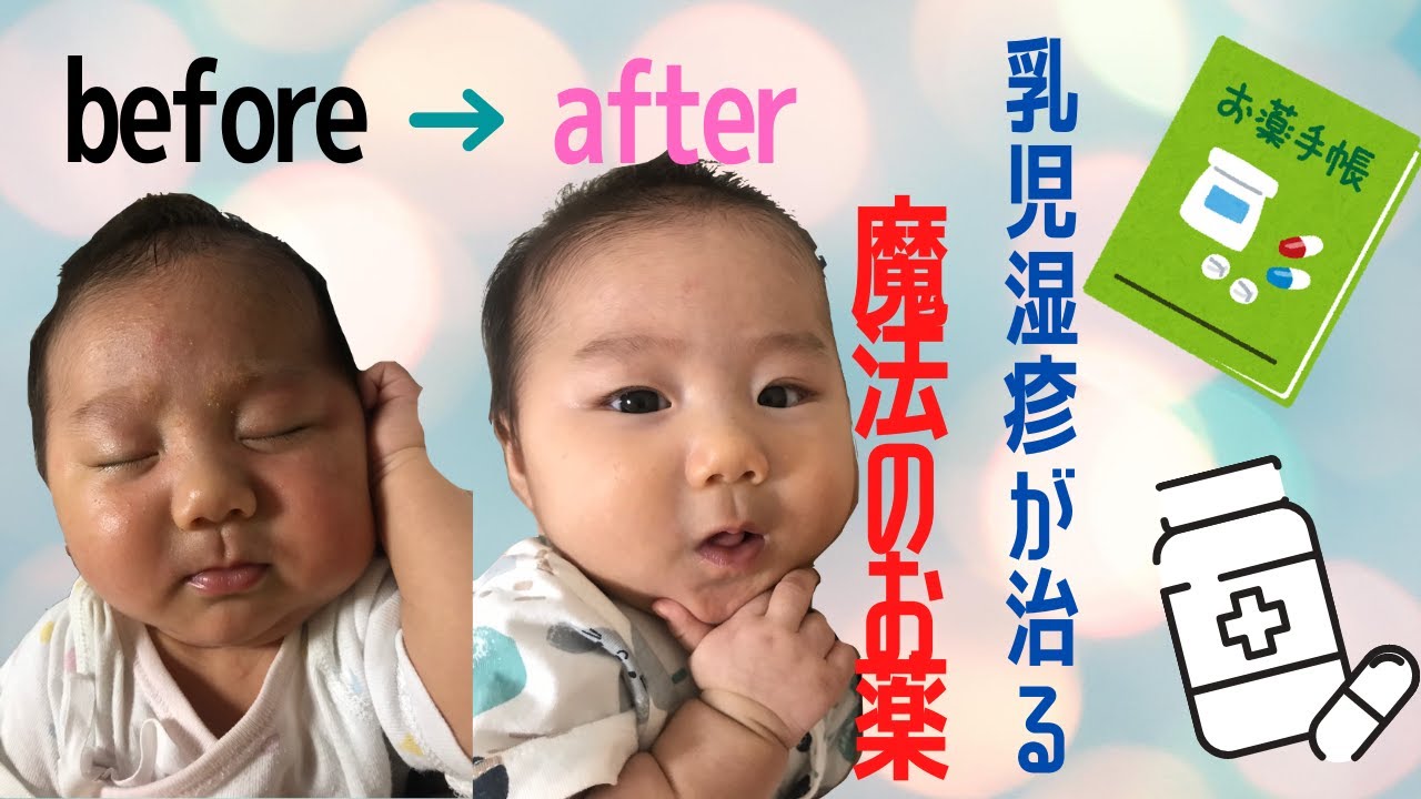 すぐ治る ヘパリン類似物質って 赤ちゃんの乳児湿疹ケアアイテム Youtube