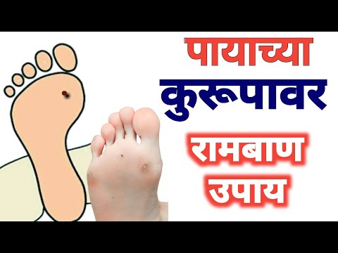 पायाच्या कुरूपावर हमखास खात्रीशीर उपाय। पायात काटा मोडल्यास | kurup zalyavar upay