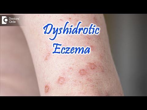 Video: Dyshidrotic Epidermophytosis - Gejala Dan Rawatan Epidermophytosis Dyshidrotic Pada Kanak-kanak