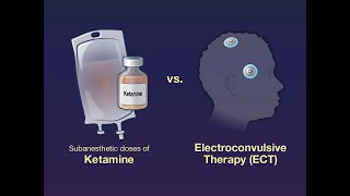 Ketamine vs. ECT for Major Depression | NEJM