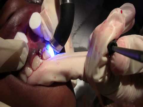 The Emergency Repair of Luxated Teeth