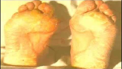 Hay Algún Tipo De Psoriasis Que Cure Totalmente