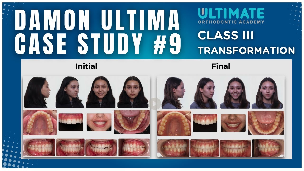 Damon Ultima Class III Transformation- 14- Month Orthodontic Case Study