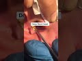Removed black head