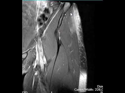 Partial tear of the proximal iliotibial band (ITB) resulting in