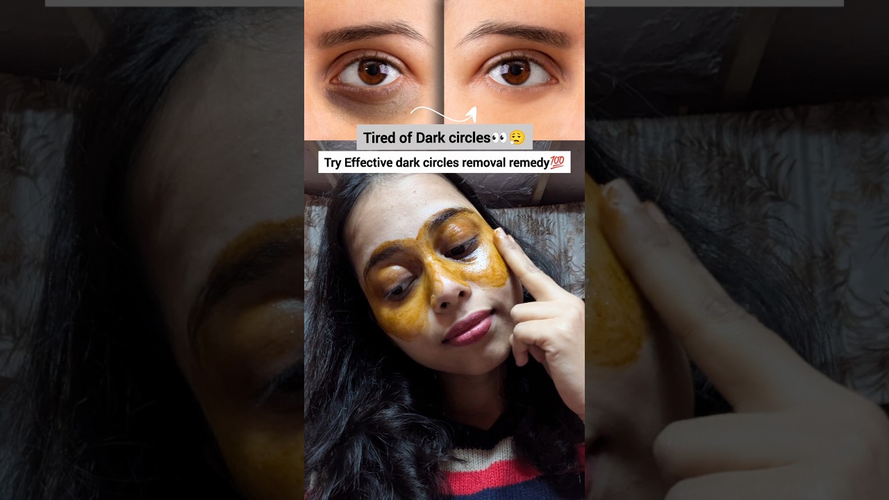 Tired of Dark circles😮‍💨try this Remedy once & see 💯Results after first use✨ 
