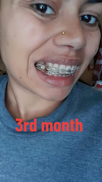 6 months journey of Braces ll 4 tooth extraction ll  #braces Part-1