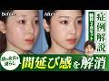 輪郭3点手術でここまで変わる｜顔の余白が減る理由を症例で解説