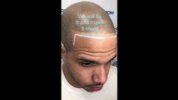 Fixing BAD ScalpMicropigmentation