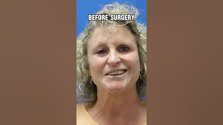 Watch her smile come back to life after surgery 😊#facialparalysis #bellspalsy #selectiveneurolysis