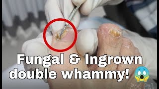 Treating fungal Ingrown toenails, 무좀, 발톱 곰팡이균과 내성발톱 동시에 치료, 甲溝炎, 內生甲, 嵌甲, 陥入爪