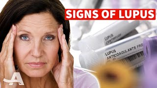 5 Early Signs of Lupus