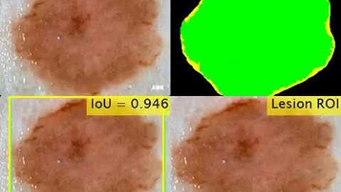 Segmentation Results Using DSNet on ISIC 2018