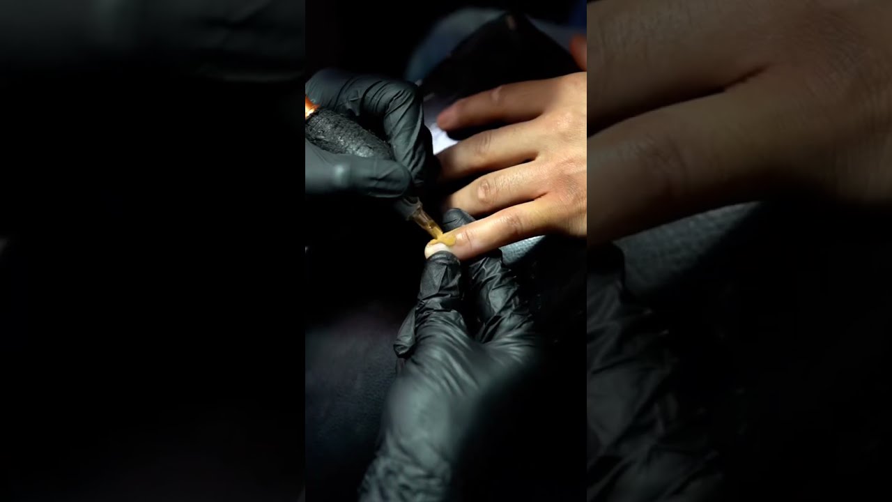 Vitiligo Skin Color Tattoo Coverup Disease Treatment