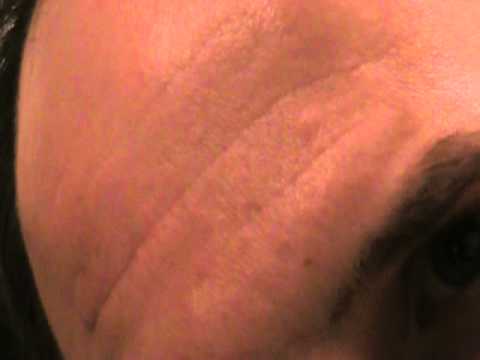 Lipoma removal scar