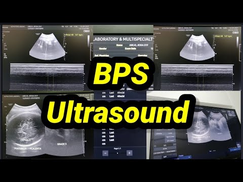 Video: Apakah ultrasound profil biofizik?