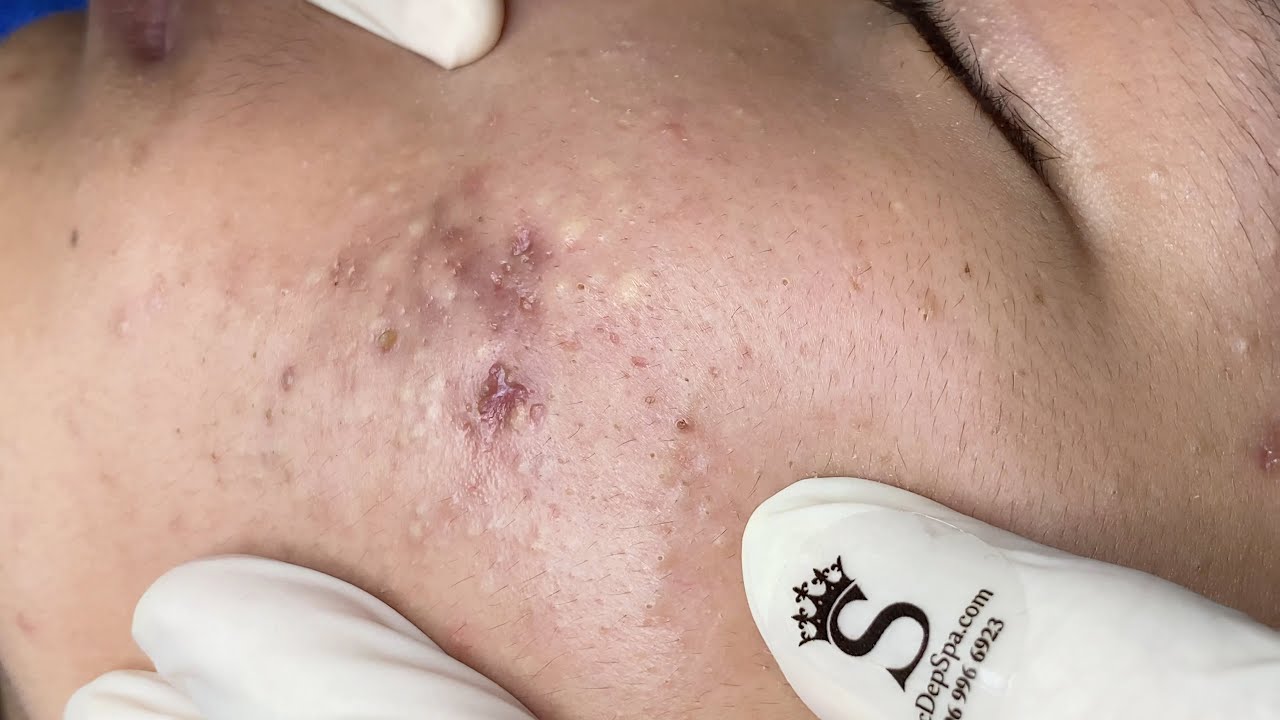 Inflammatory Acne P2.1 (Minh) | Mụn Viêm Tụ Máu P2.1 (Minh) - SacDepSpa#346