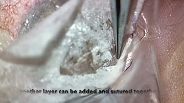 Amniotic membrane grafting for persistent corneal epithelial defect