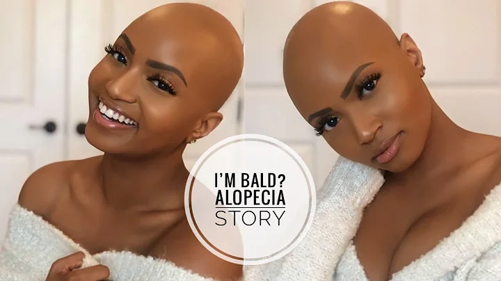 I'M BALD? MY ALOPECIA STORYTIME