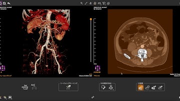 Bone removal and edit