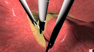 Position Based Dynamics based Virtual Surgery Demo