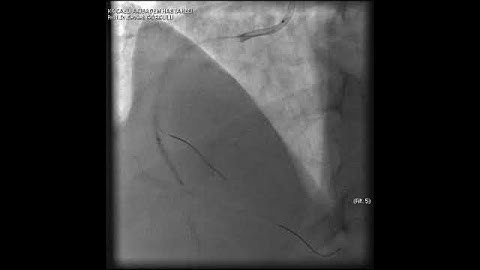 Complex PCI for RCA CTO with bifurcation at distal cap video 7