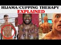 Hijama  cupping therapy explained