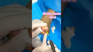 #callus #warttreatment #foot #laser #plantarwartremoval |Best Podiatrist in Bengaluru|Dr Amit Jain