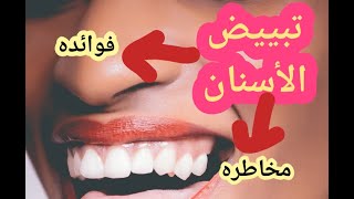 تبييض الأسنان.فوائده و مخاطره. جميع الأسئلة المتعلقة بتبييض الأسنان. blanchiment  dentaire