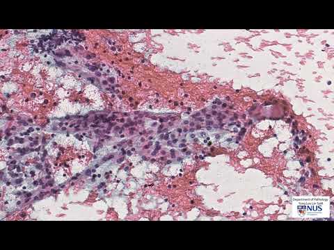 Thyroid cytology: Lymphocytic thyroiditis