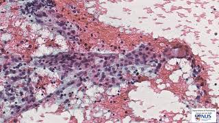 Thyroid cytology: Lymphocytic thyroiditis