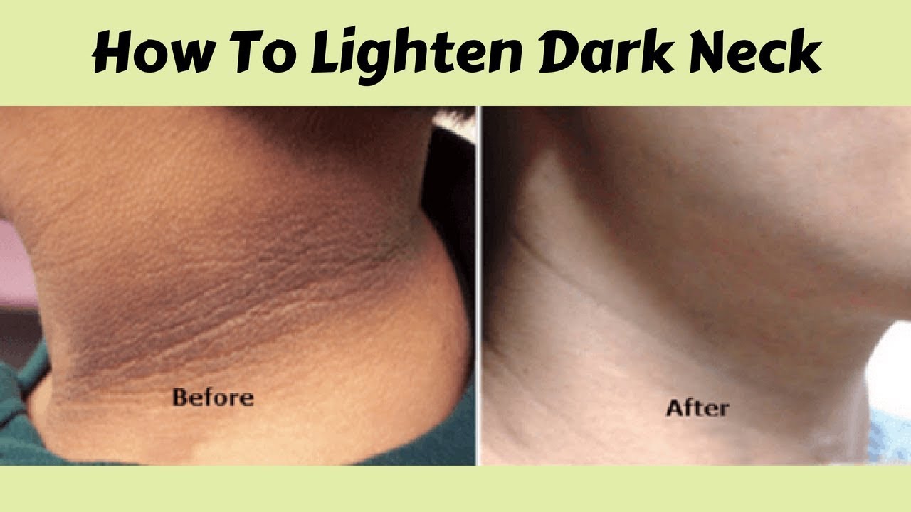How To Get Rid Of Dark Neck Naturally(Quick And Easy Way) - YouTube 