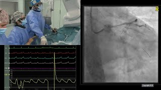 Optimising treatment for patients with severe calcified lesions: the role of orbital atherectomy