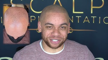 Scalp Micropigmentation Super happy client