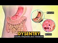 What is Dysentery? Causes, Signs and symptoms, Diagnosis and treatment.