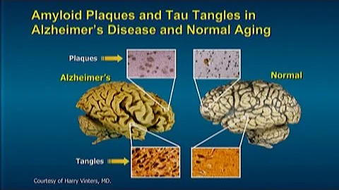 Quels aliments contre la maladie d'Alzheimer ?