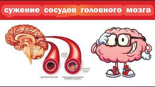 Рецепт от сужения сосудов головного мозга. Как растворить бляшки в сосудах